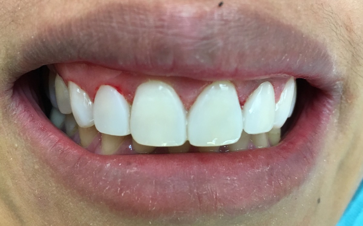 5 Teeth Veneered