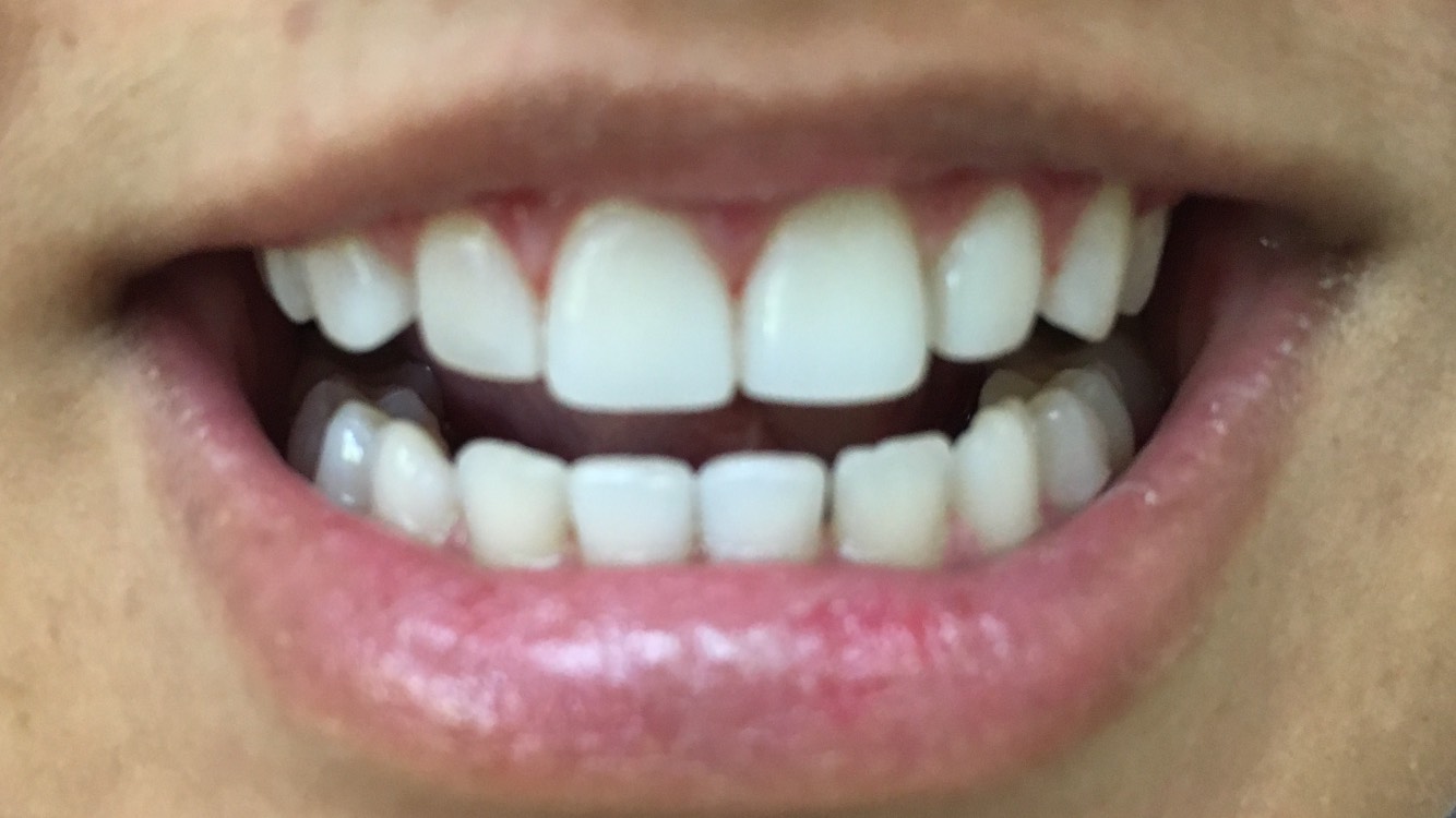 Gaps between the upper and lower front teeth