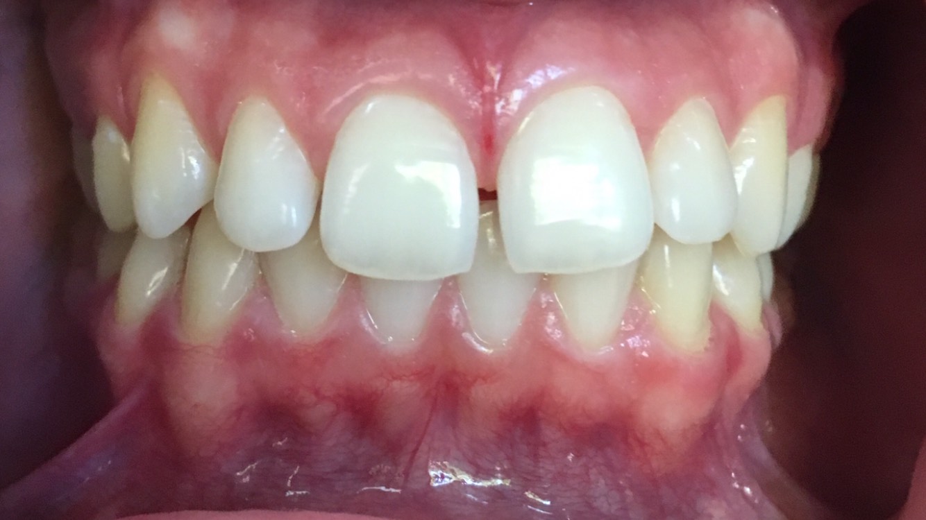 Gaps between the upper and lower front teeth
