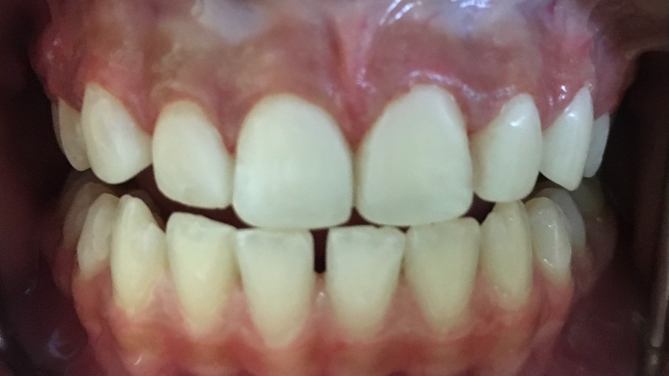 Gaps between the upper and lower front teeth