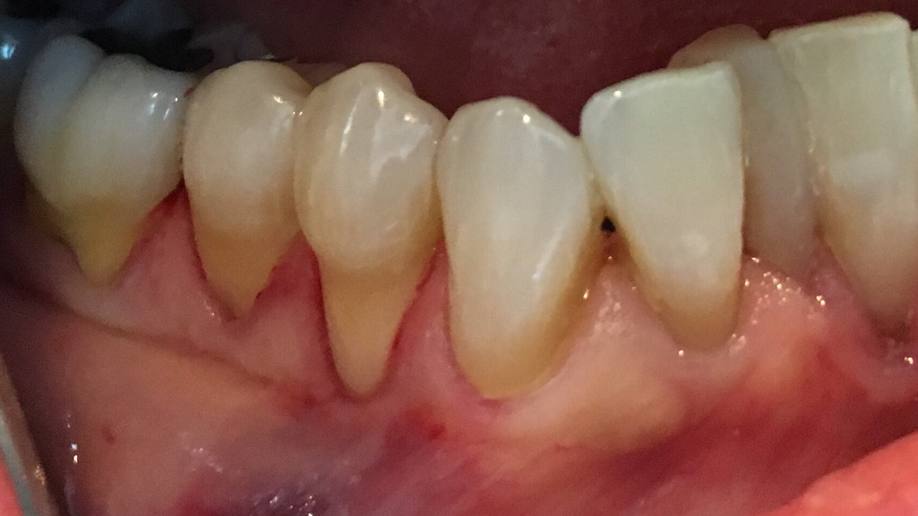 severe gum recession