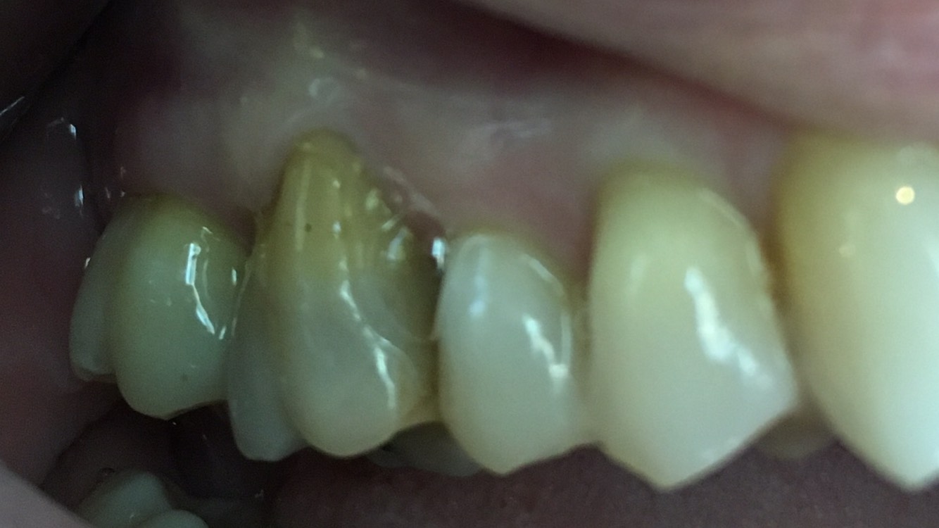 Gum Surgery – Case 2