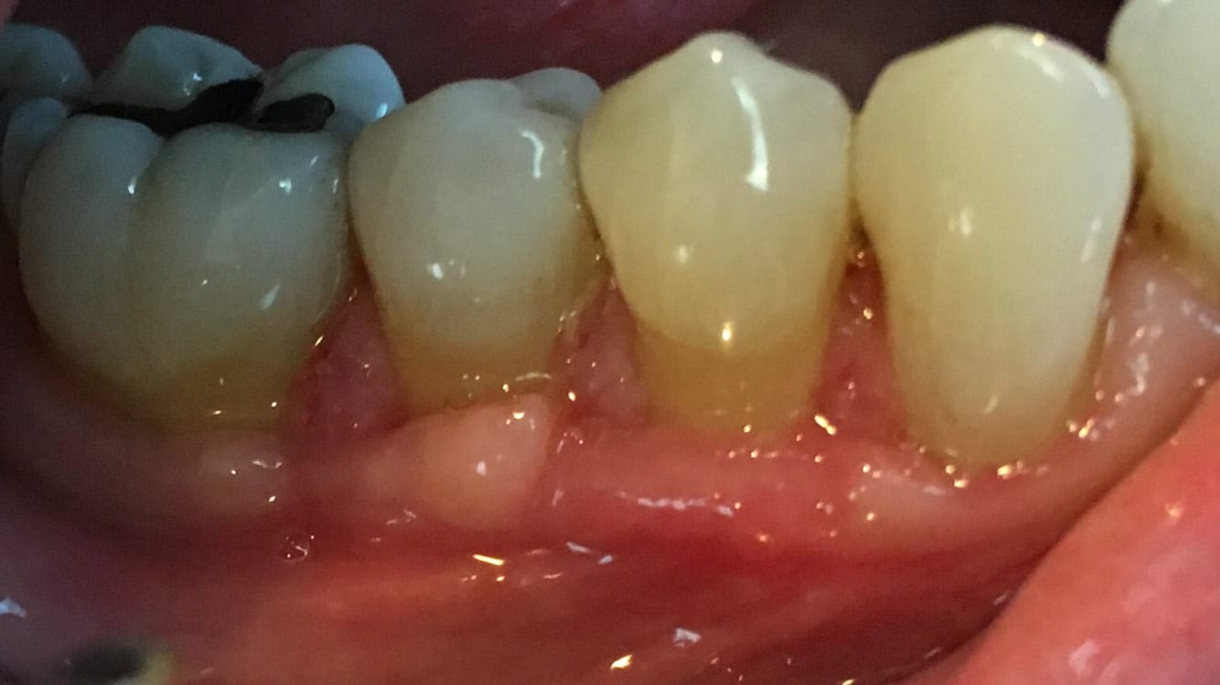 Three Months After Gum Graft 