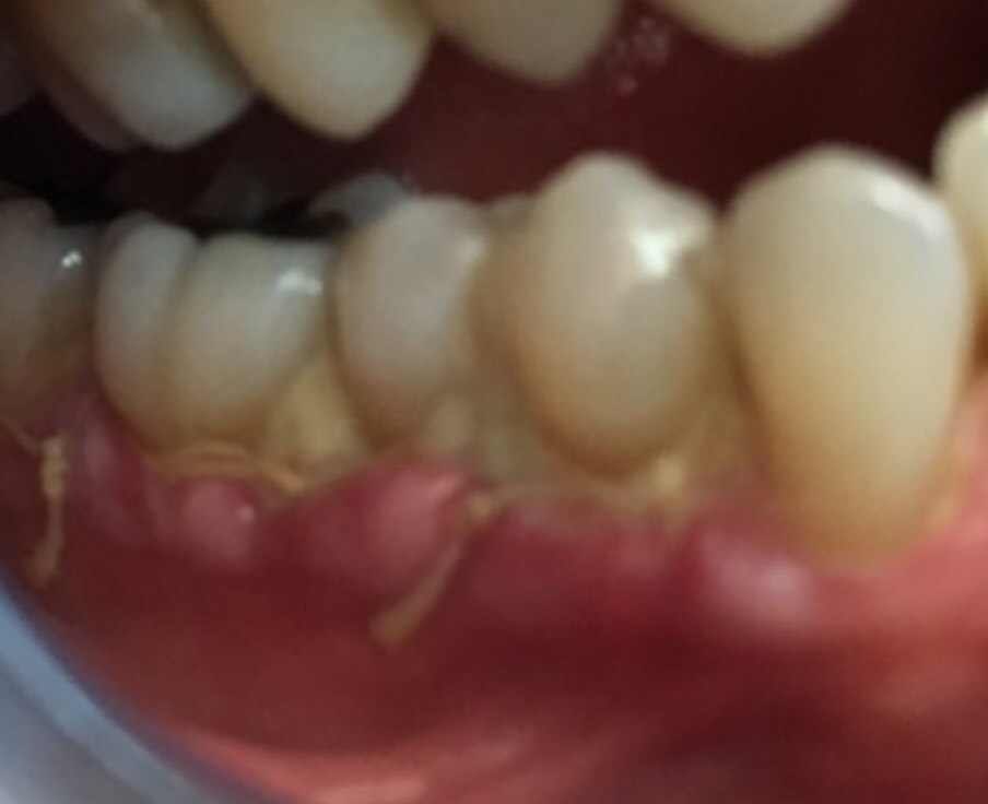 One Week After Gum Graft