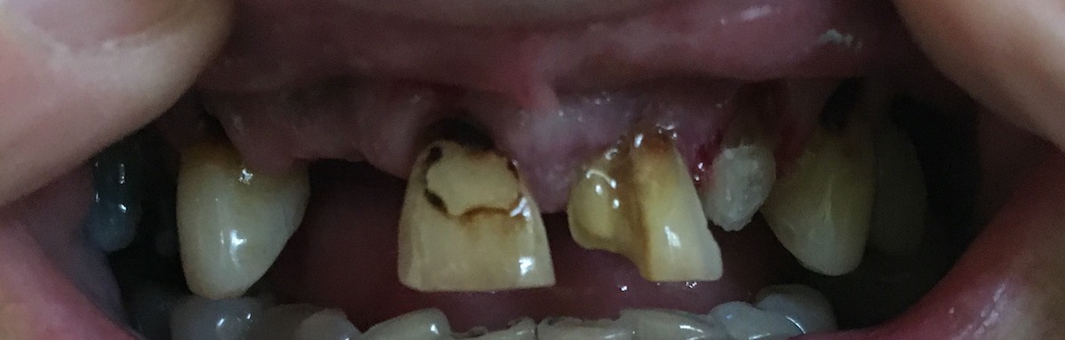 Broken front tooth
