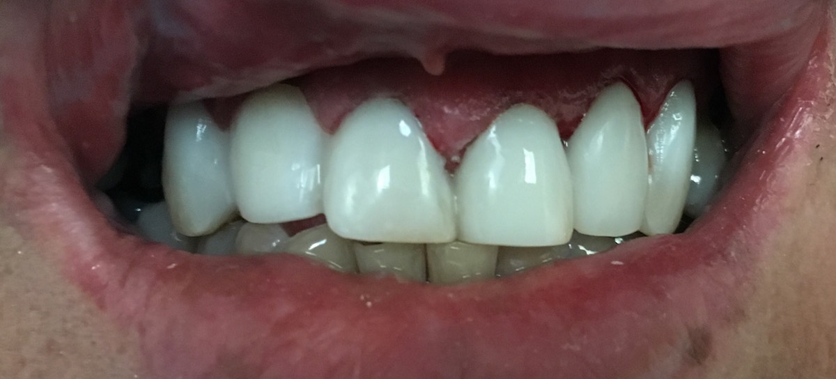 Broken front tooth