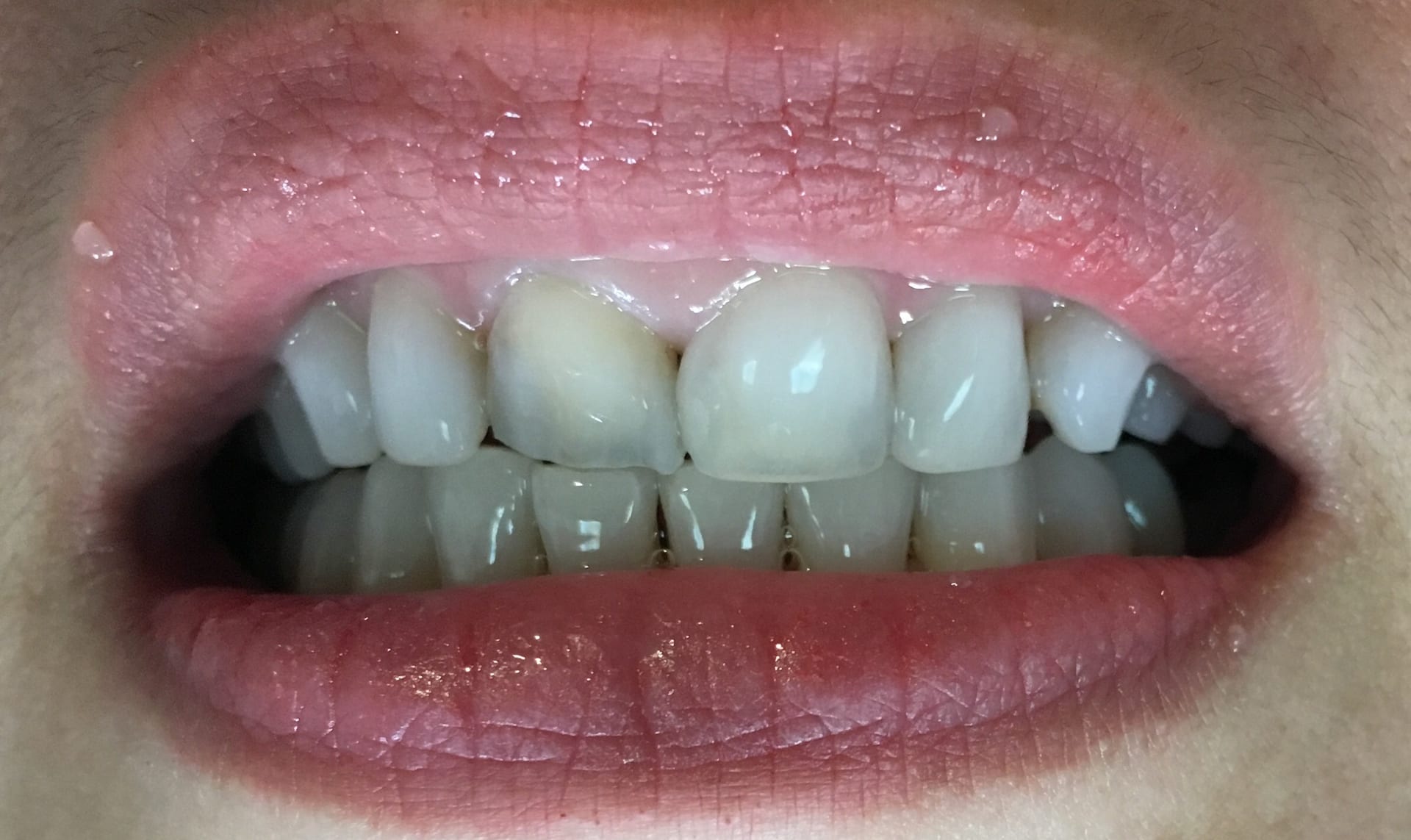 Patient broke her tooth