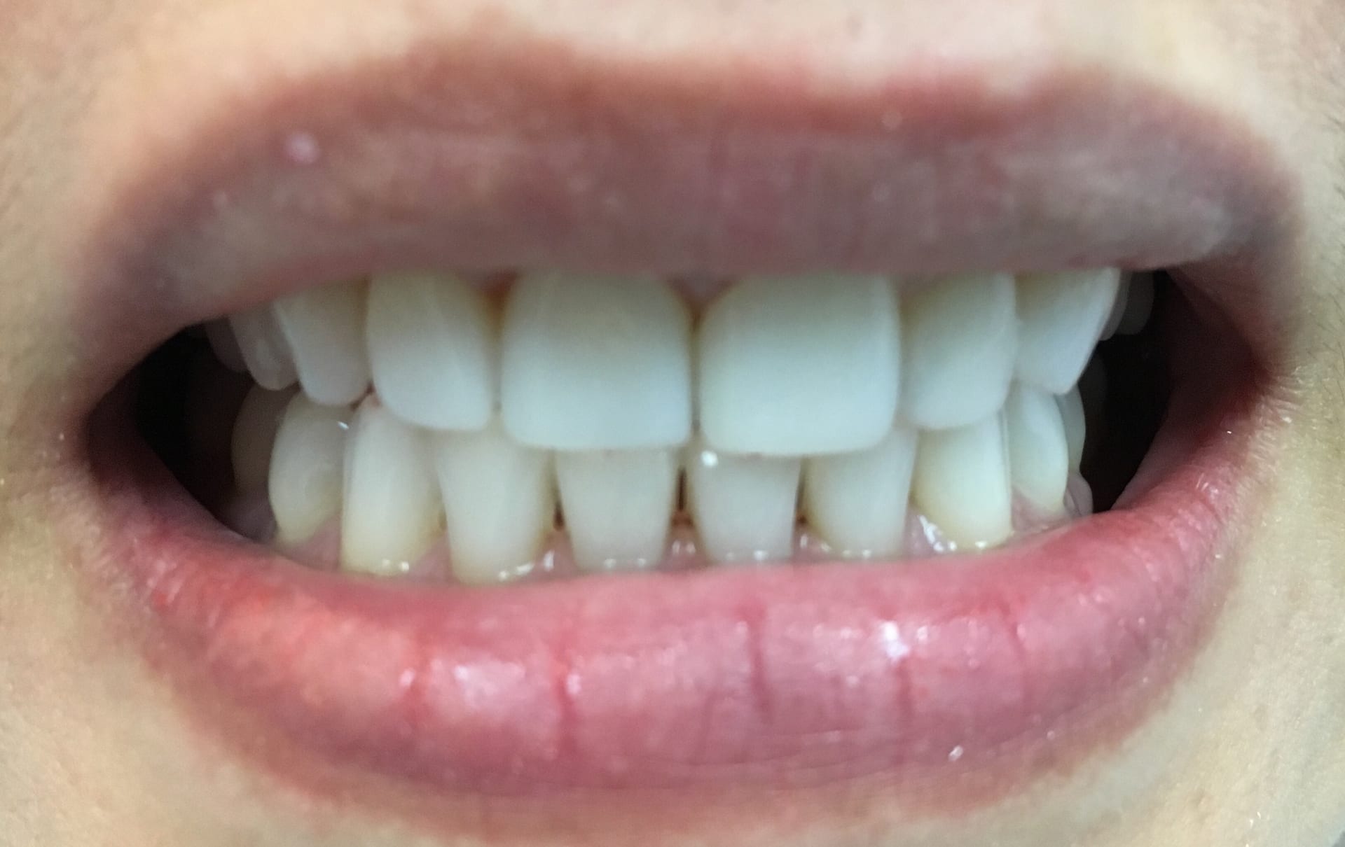 Patient broke her tooth