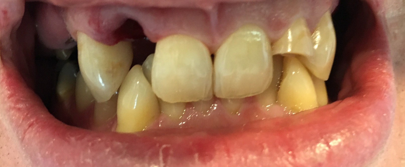 Pontic Tooth