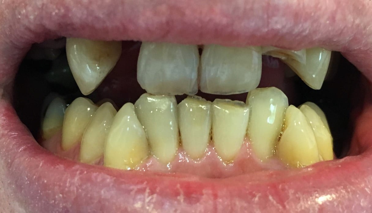 Pontic Tooth