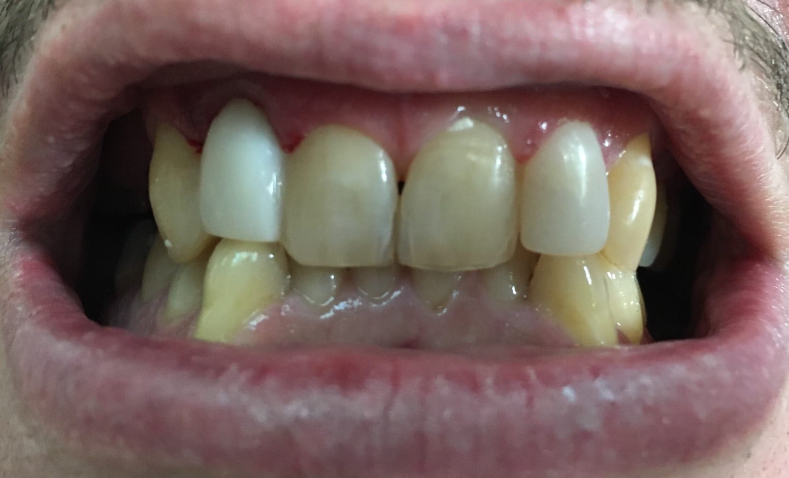 Pontic Tooth