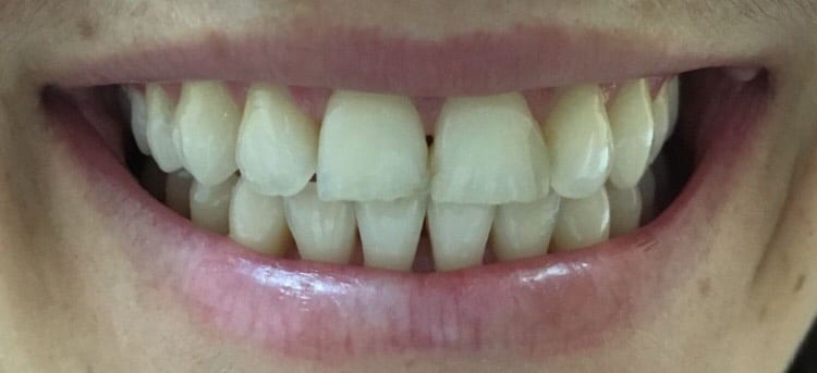 After 2 hours with white composite fillings in one visit