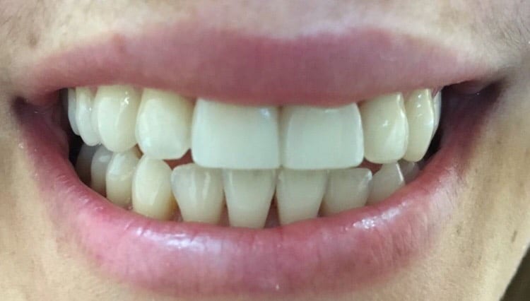 After 2 hours with white composite fillings in one visit