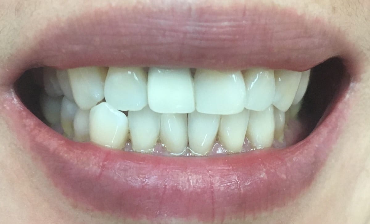Composite Veneer On The Dark Crown