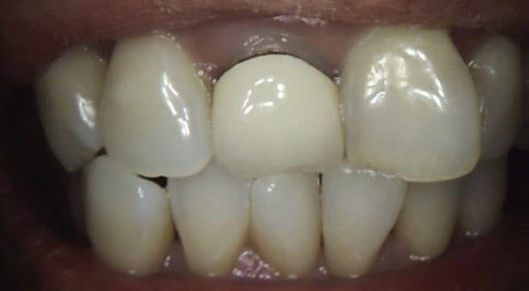 Composite Veneer On The Dark Crown