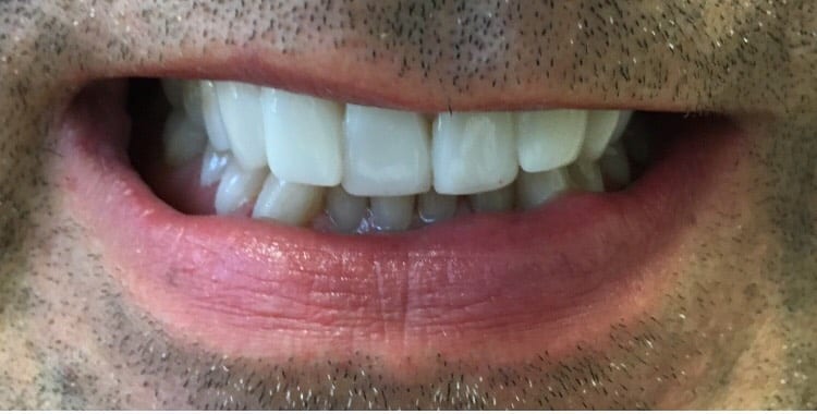 15 Teeth