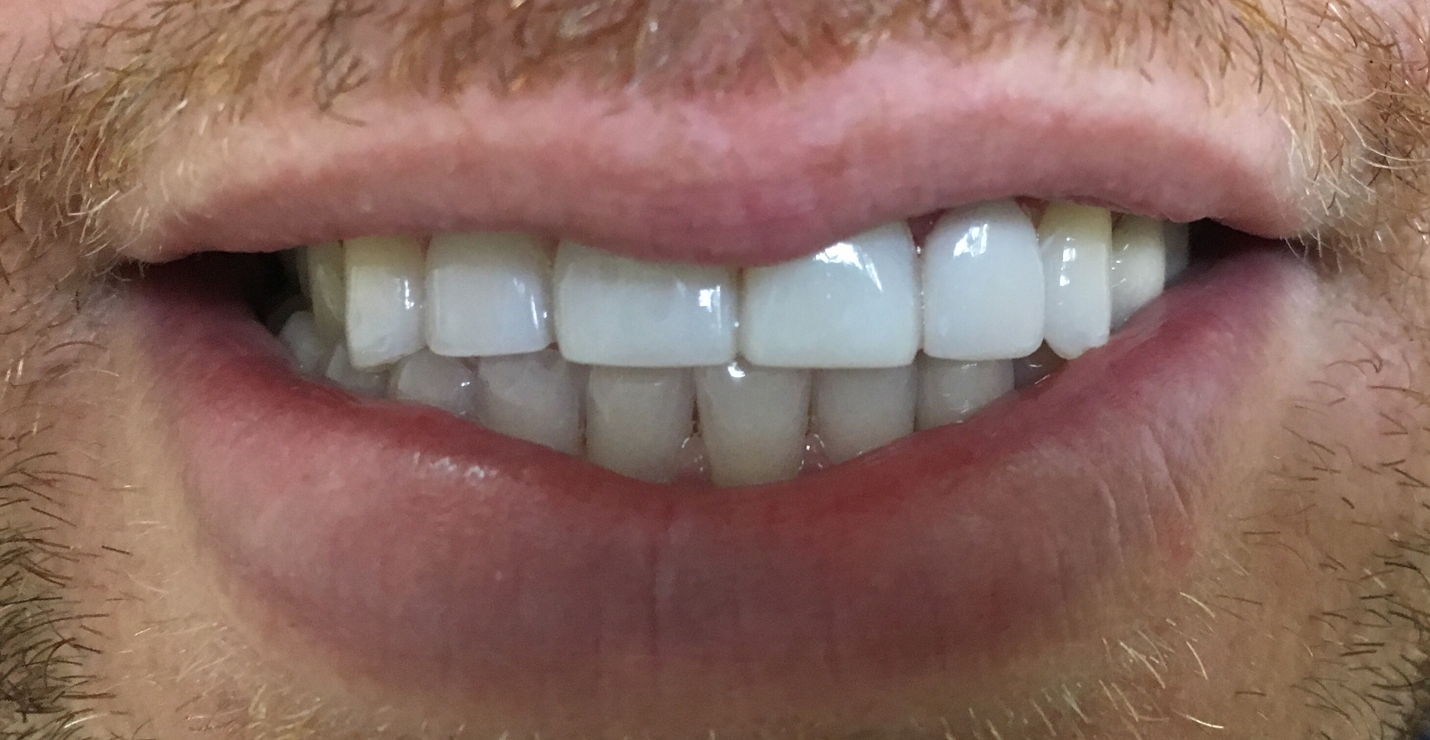 4 Composite Veneers