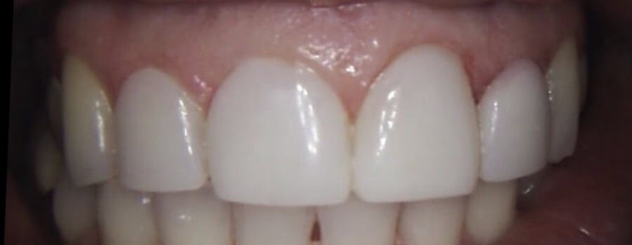 4 Composite Veneers