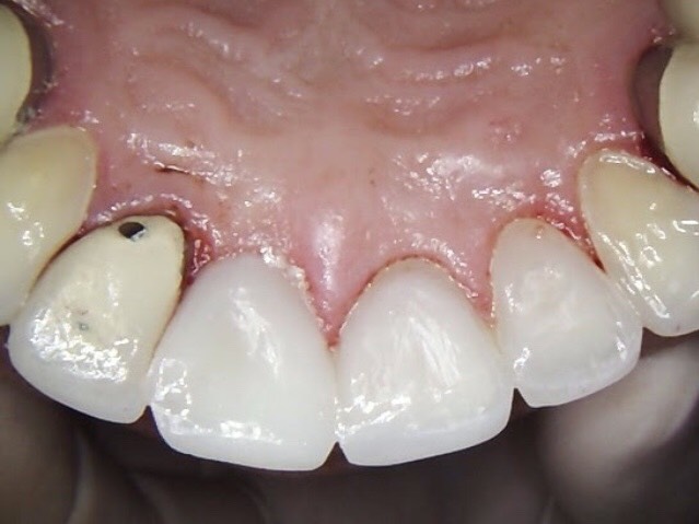 4 Composite Veneers