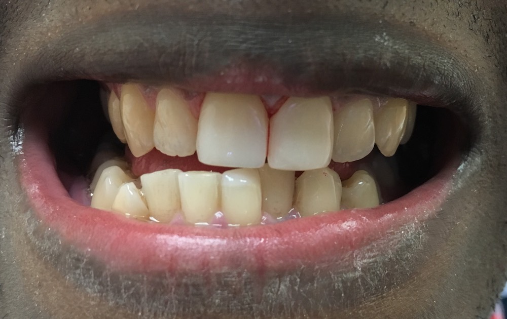 Composite Veneers