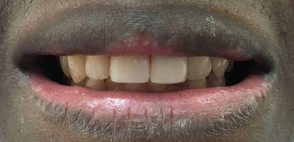 Composite Veneers