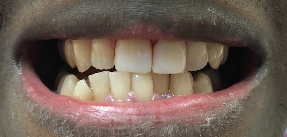Composite Veneers