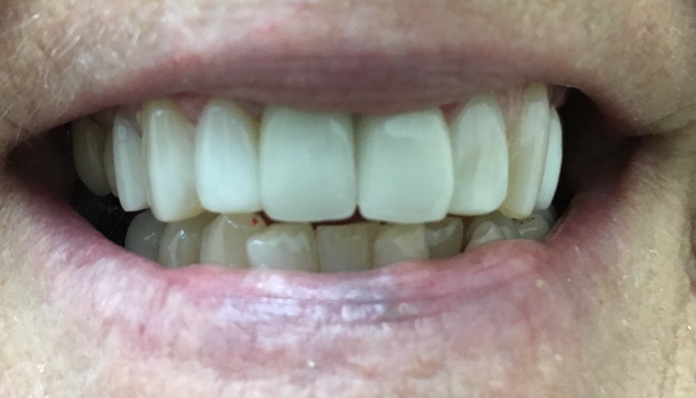 CEREC Crowns