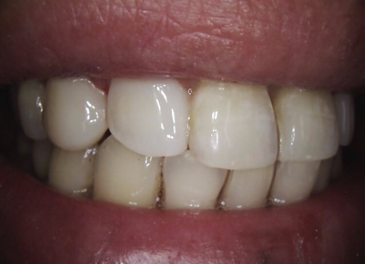2 composite veneers