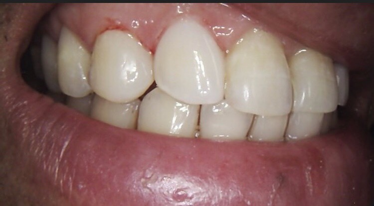 2 composite veneers