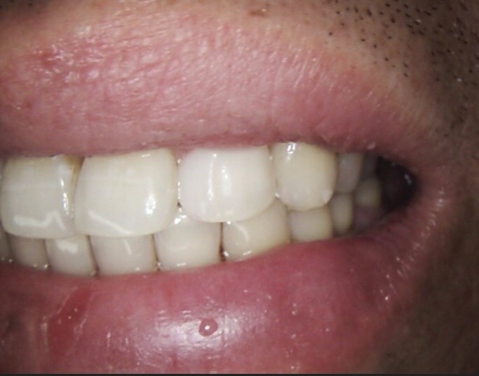 2 composite veneers