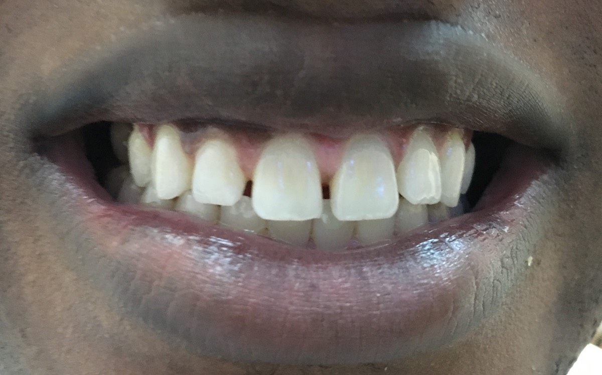 2 composite veneers