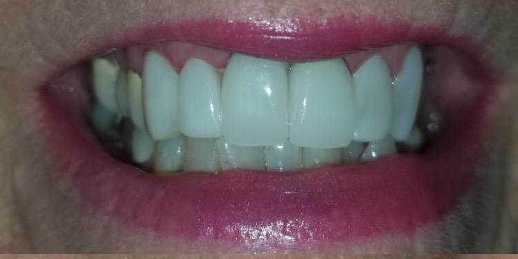 CEREC Crowns