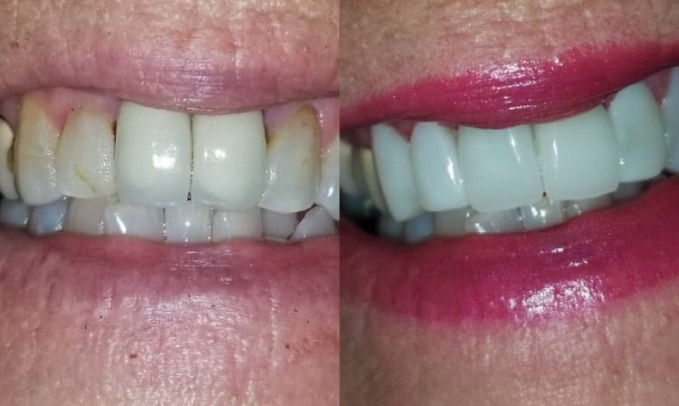 CEREC Crowns
