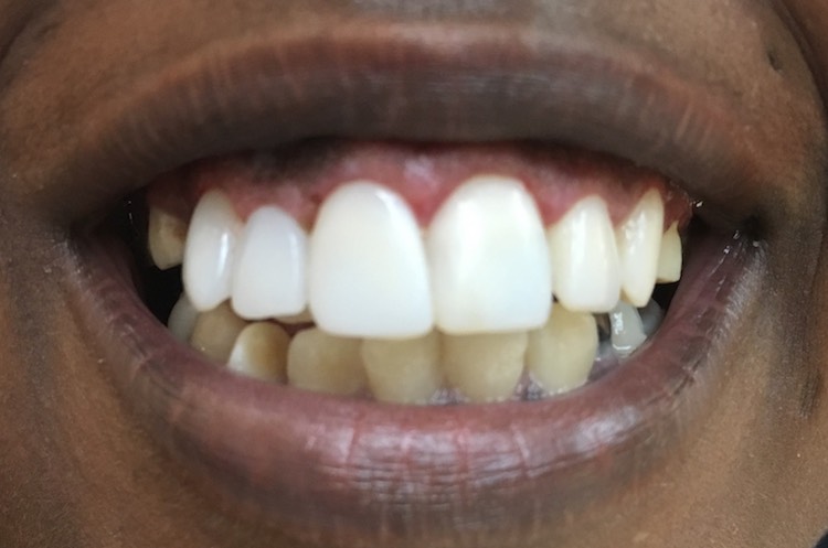 straight teeth