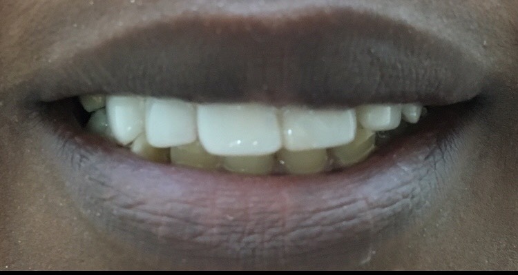 straight teeth
