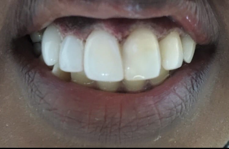 straight teeth