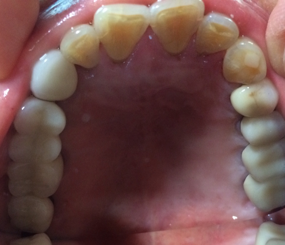 implant for me