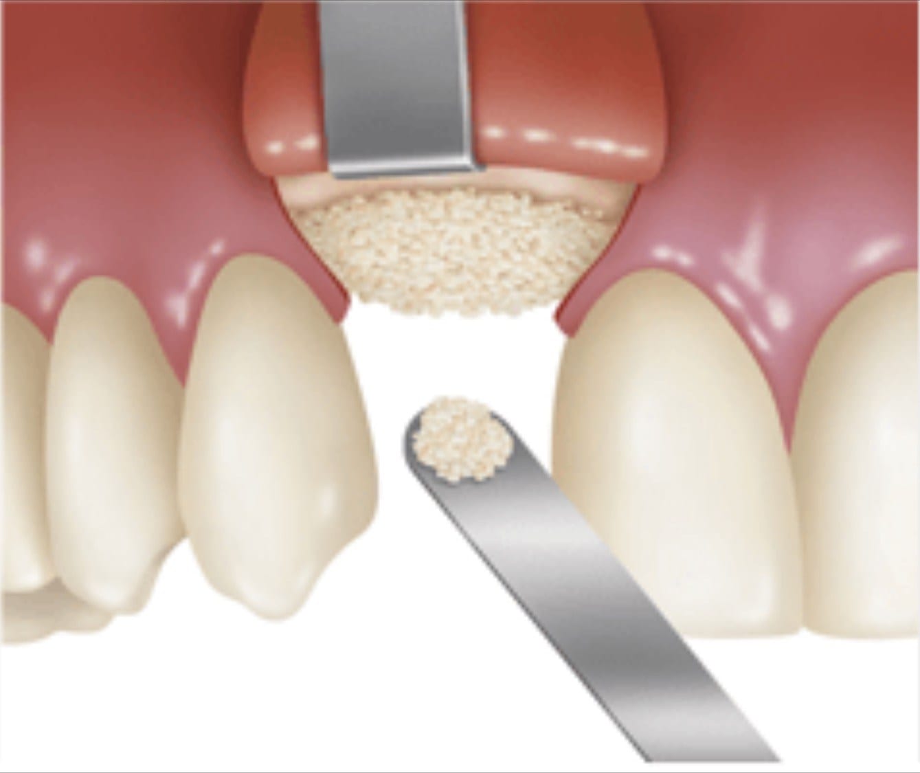 bone-graft
