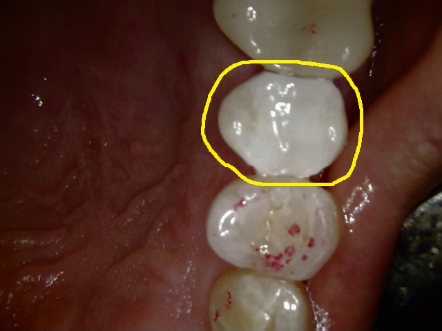 amalgam filling