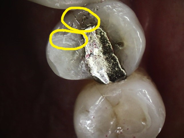 Cracked Tooth