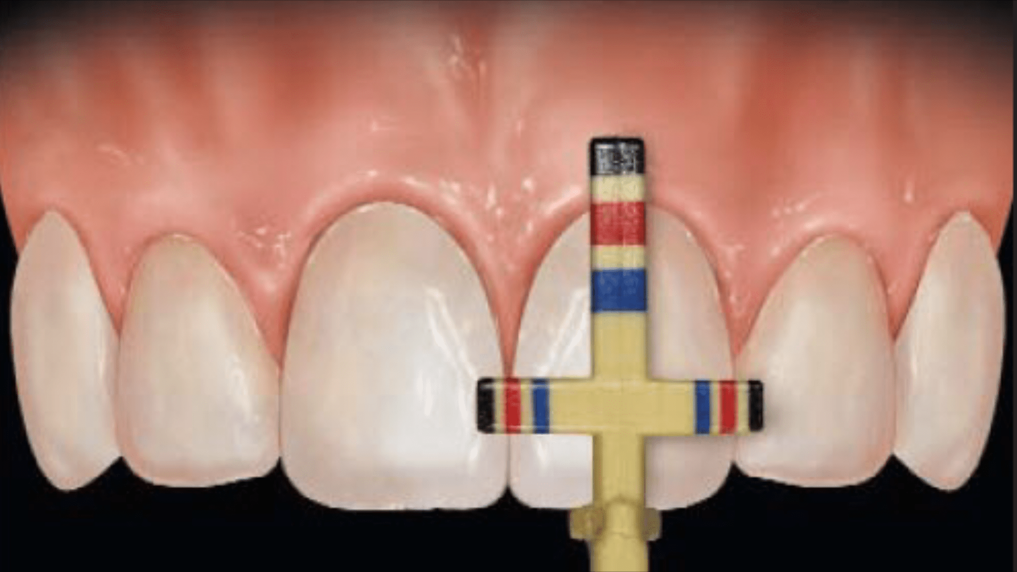 crown-lengthening