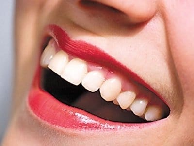 dental implant benefits