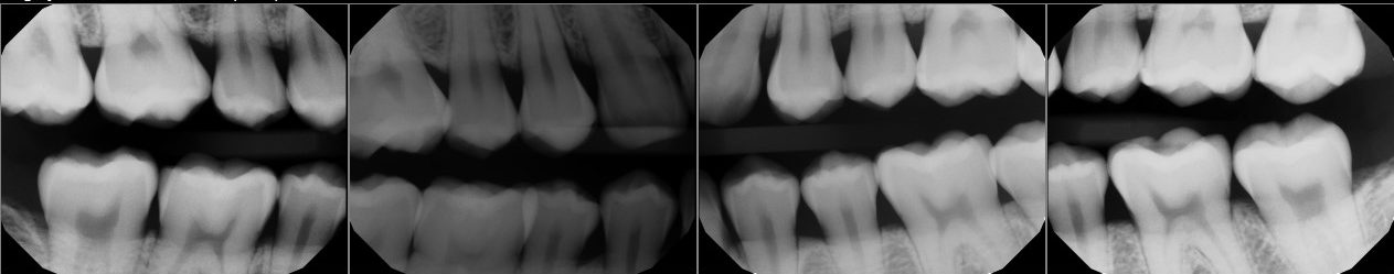 dental X-rays