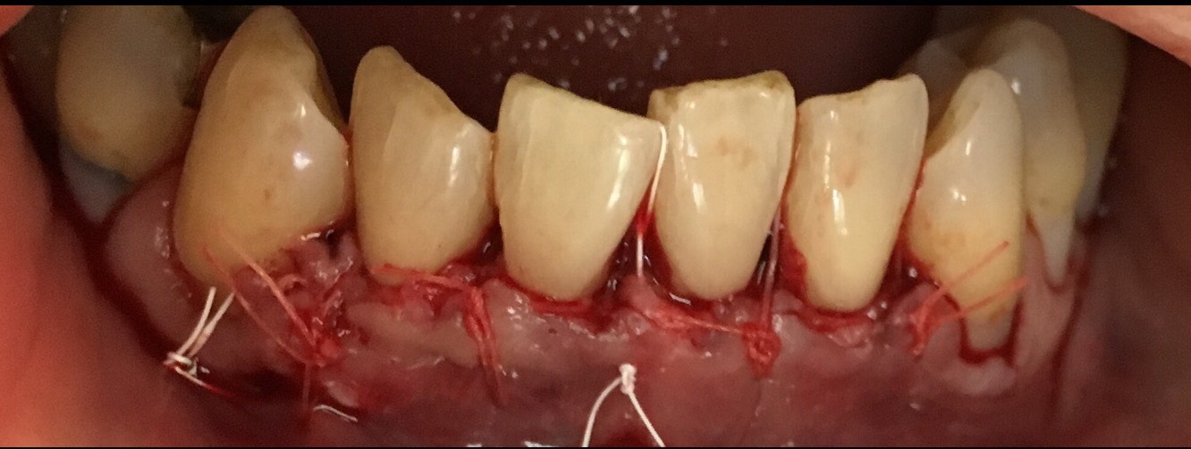 Gum surgery case 1  gum-graft