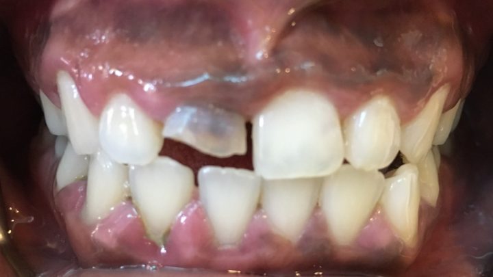 Broken Tooth in Half