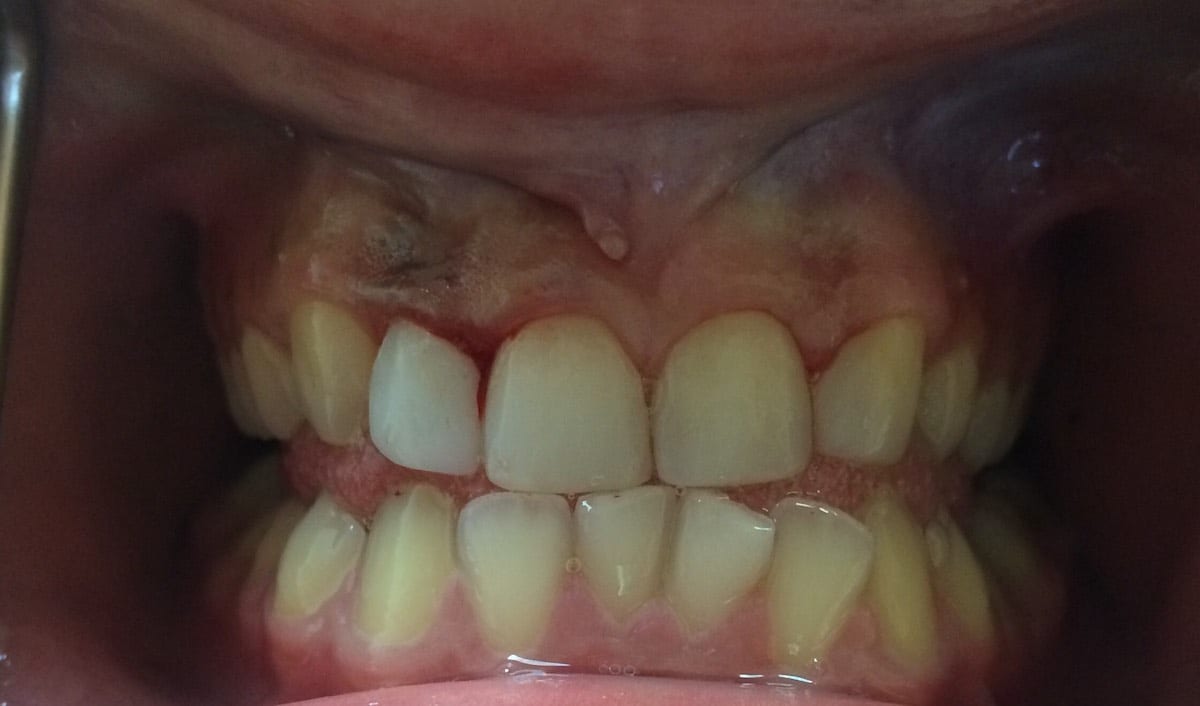 Composite fillings in 2 hours