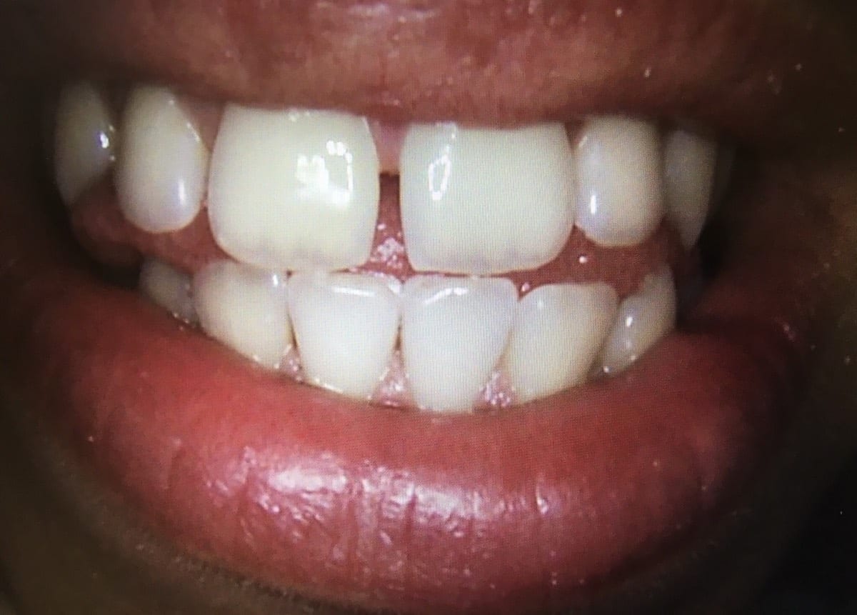 3 Teeth Veneered