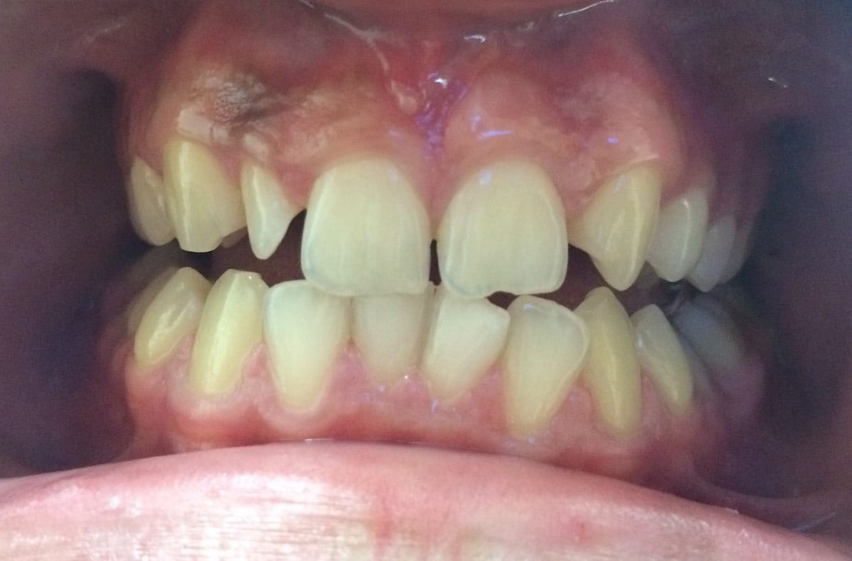 Composite fillings in 2 hours