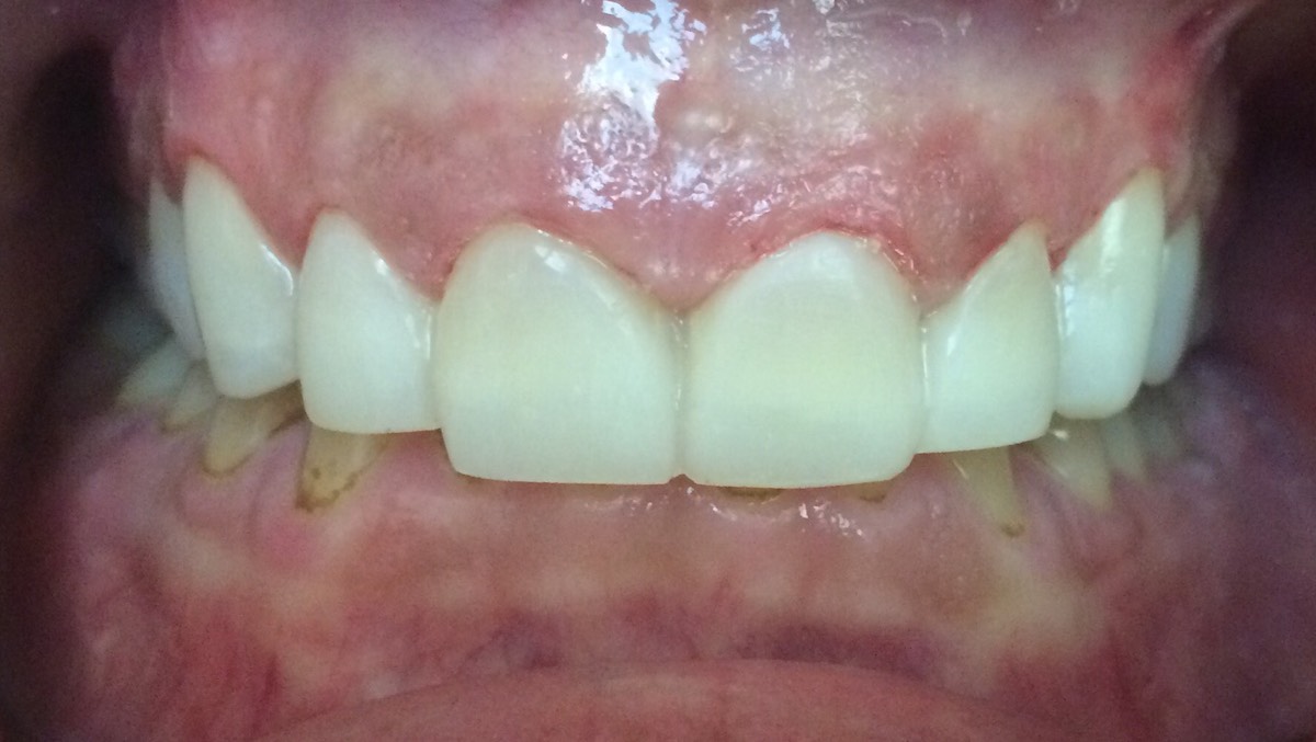 Patient's 8 Teeth