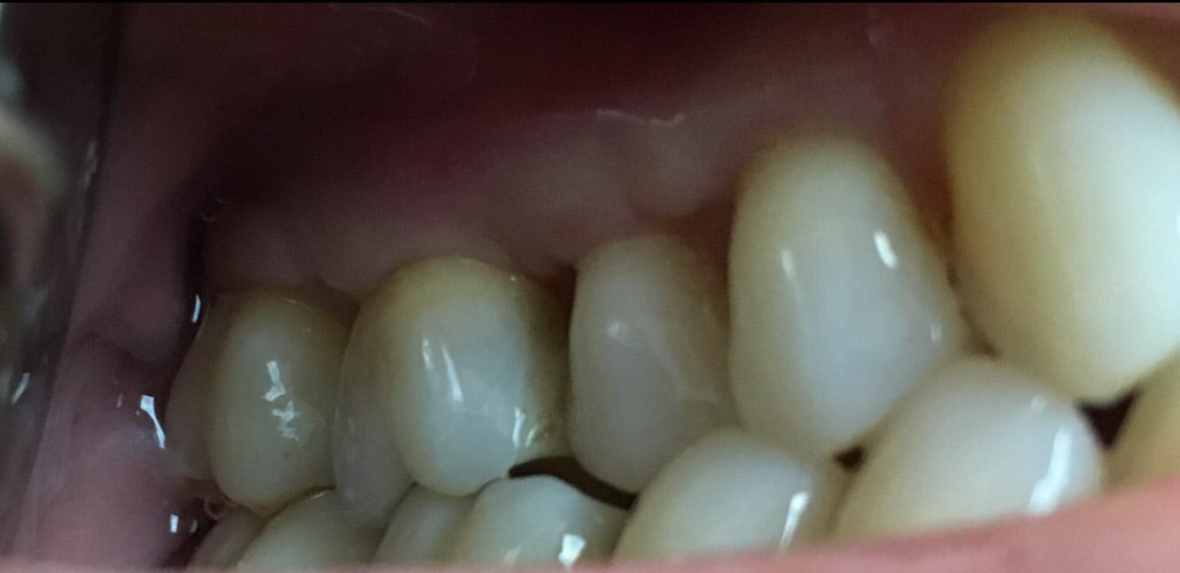 One Year After Gum Graft 